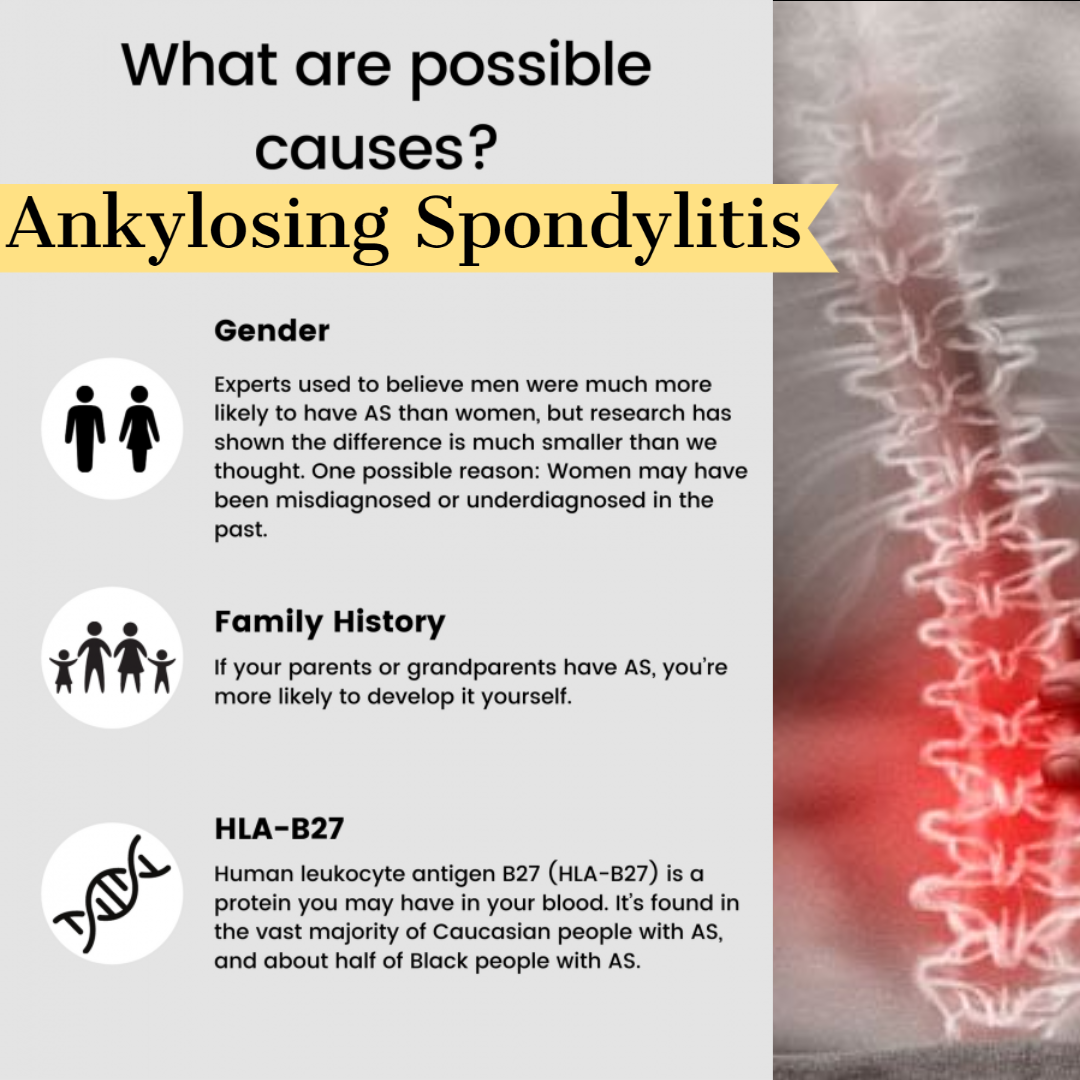 Ankylosing Spondylitissss
