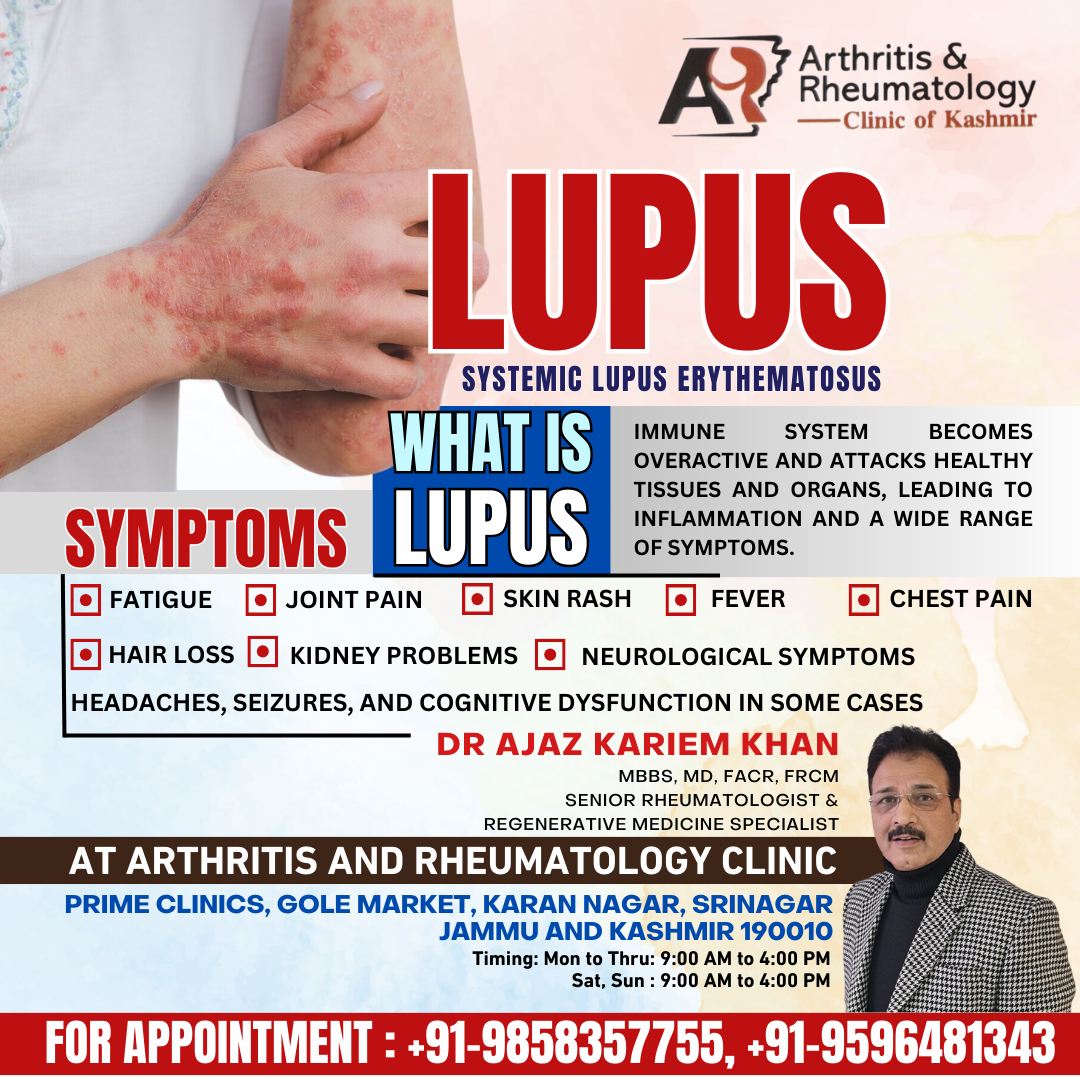 lupus symptoms and treatments in kashmir